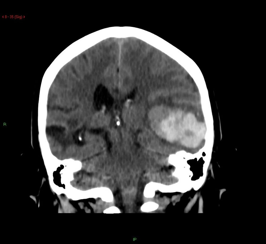Cerebral amyloid angiopathy-associated lobar intracerebral hemorrhage (Radiopaedia 58378-65518 Coronal non-contrast 35).jpg