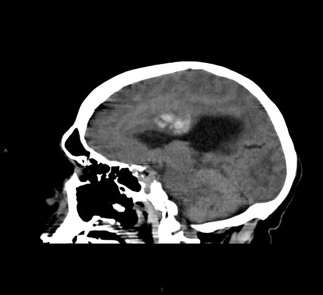File:Cerebral amyloid angiopathy-associated lobar intracerebral hemorrhage (Radiopaedia 58560-65723 C 30).jpg