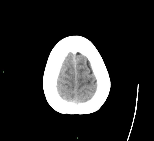 File:Cerebral amyloid angiopathy-associated lobar intracerebral hemorrhage (Radiopaedia 58563-65727 Axial non-contrast 10).jpg
