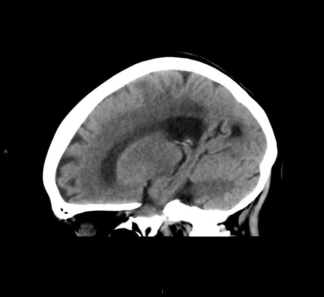 File:Cerebral amyloid angiopathy-associated lobar intracerebral hemorrhage (Radiopaedia 58563-65727 C 34).jpg