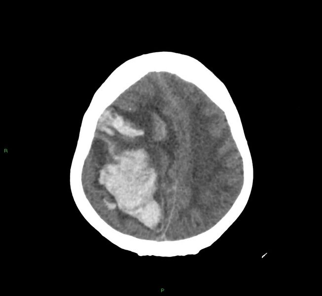 File:Cerebral amyloid angiopathy-associated lobar intracerebral hemorrhage (Radiopaedia 58751-65972 Axial non-contrast 16).jpg