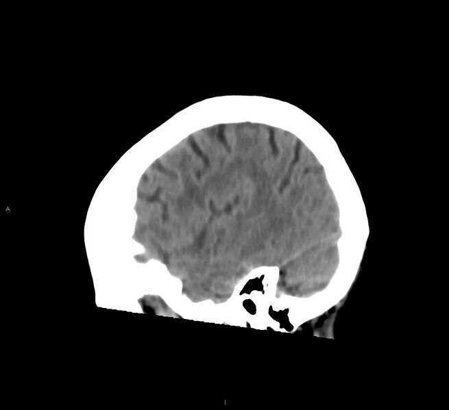 File:Cerebral amyloid angiopathy-associated lobar intracerebral hemorrhage (Radiopaedia 58754-65975 C 10).jpg