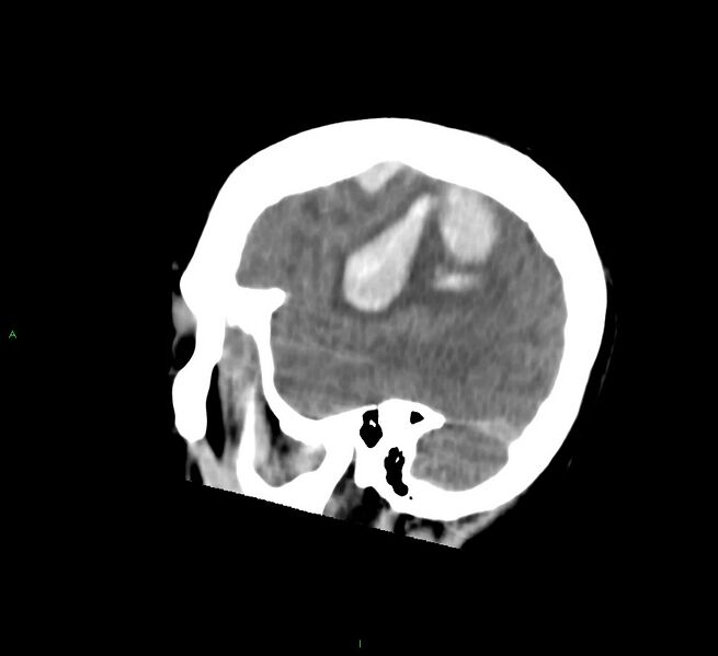 File:Cerebral amyloid angiopathy-associated lobar intracerebral hemorrhage (Radiopaedia 58756-65977 C 14).jpg