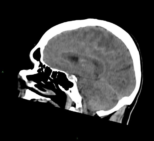 File:Cerebral amyloid angiopathy-associated lobar intracerebral hemorrhage (Radiopaedia 58756-65977 C 33).jpg