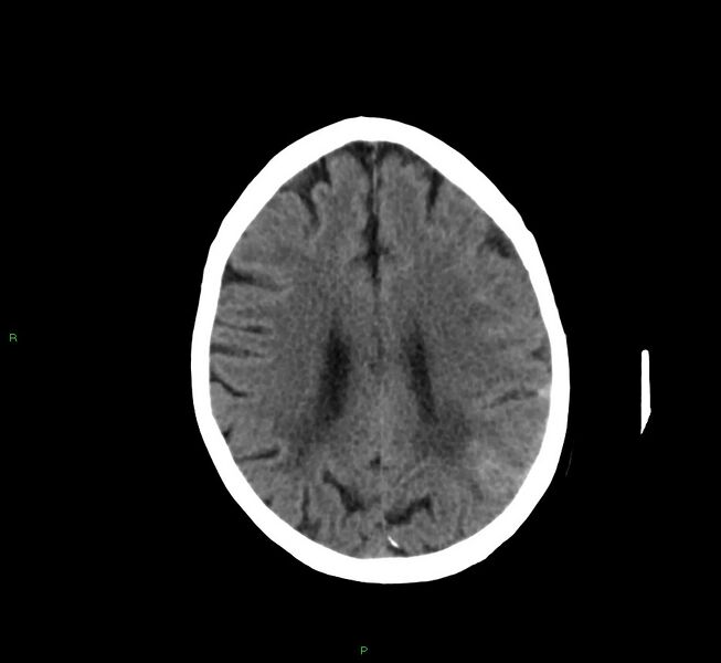 File:Cerebral amyloid angiopathy-associated lobar intracerebral hemorrhage (Radiopaedia 58757-65978 Axial non-contrast 20).jpg