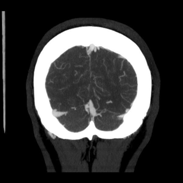 File:Cerebral arteriovenous malformation (Radiopaedia 43729-47189 C 42).jpg