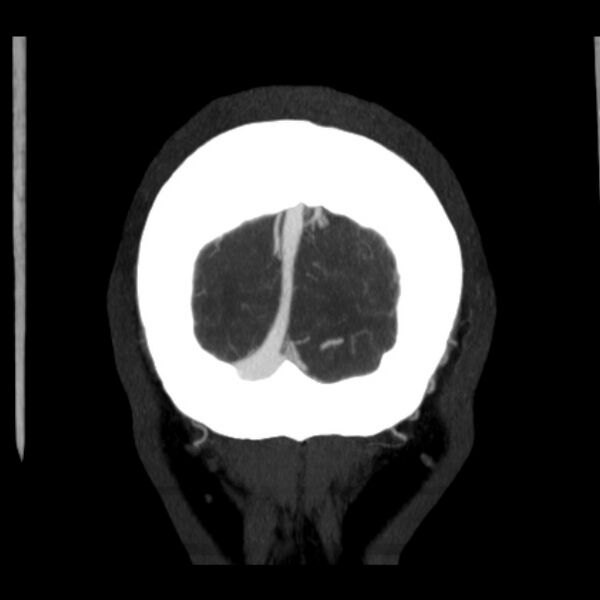 File:Cerebral arteriovenous malformation (Radiopaedia 43729-47189 C 46).jpg