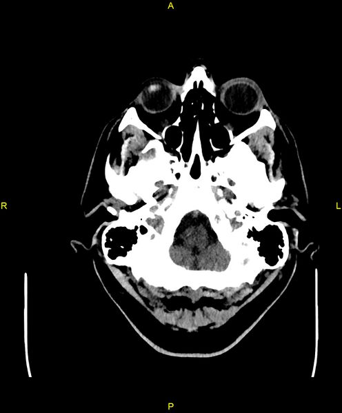 File:Cerebral autosomal dominant arteriopathy with subcortical infarcts and leukoencephalopathy (CADASIL) (Radiopaedia 86108-102051 Axial non-contrast 11).jpg