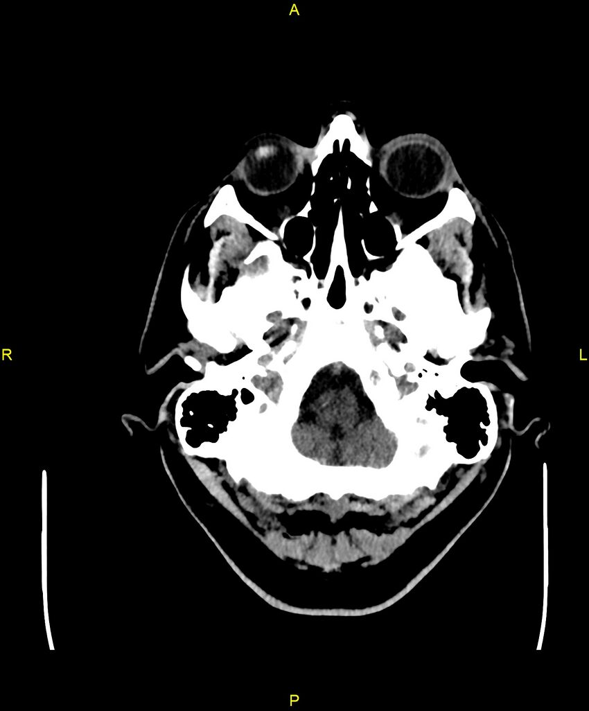 Cerebral autosomal dominant arteriopathy with subcortical infarcts and leukoencephalopathy (CADASIL) (Radiopaedia 86108-102051 Axial non-contrast 11).jpg