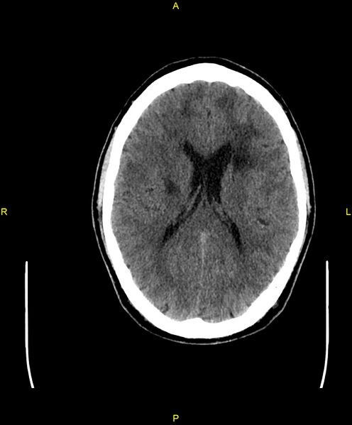File:Cerebral autosomal dominant arteriopathy with subcortical infarcts and leukoencephalopathy (CADASIL) (Radiopaedia 86108-102051 Axial non-contrast 64).jpg