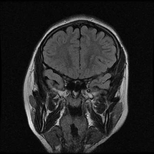 File:Cerebral cavernous malformation (Radiopaedia 44301-47942 Coronal FLAIR 3).jpg