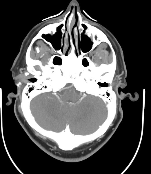 File:Cerebral dural venous sinus thrombosis (Radiopaedia 86514-102576 A 33).jpg