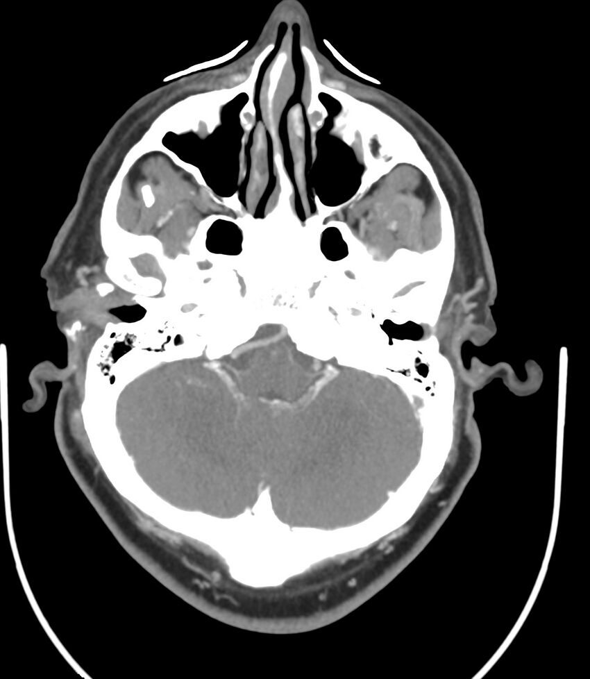 Cerebral dural venous sinus thrombosis (Radiopaedia 86514-102576 A 33).jpg