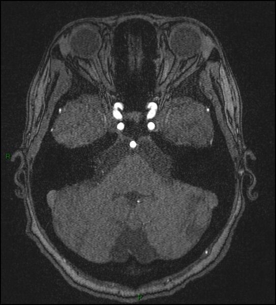 File:Cerebral fat embolism (Radiopaedia 35022-36525 Axial TOF 47).jpg