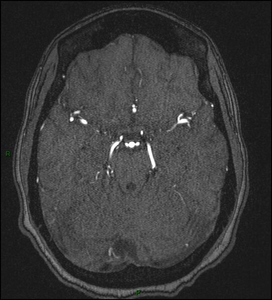 File:Cerebral fat embolism (Radiopaedia 35022-36525 Axial TOF 75).jpg