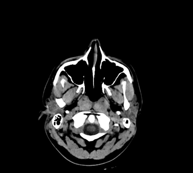 File:Cerebral fat embolism (Radiopaedia 37510-39362 Axial non-contrast 4).jpg