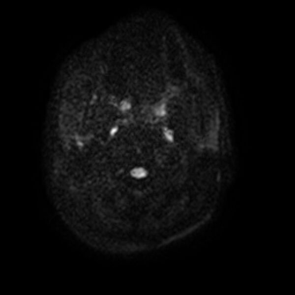 File:Cerebral fat embolism (Radiopaedia 37510-39363 Axial DWI 1).jpg