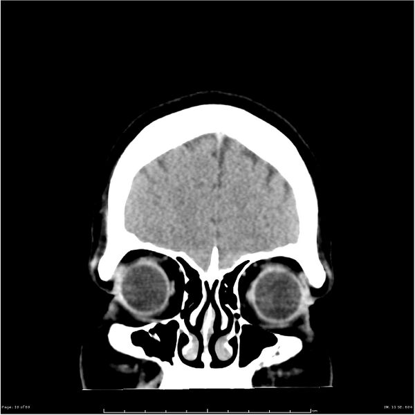 File:Cerebral hemorrhage secondary to arteriovenous malformation (Radiopaedia 33497-34561 Coronal non-contrast 1).jpg