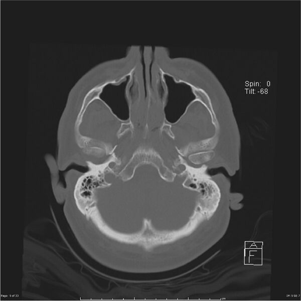 File:Cerebral hemorrhagic contusions and cervical spine fractures (Radiopaedia 32865-33841 Axial bone window 5).jpg