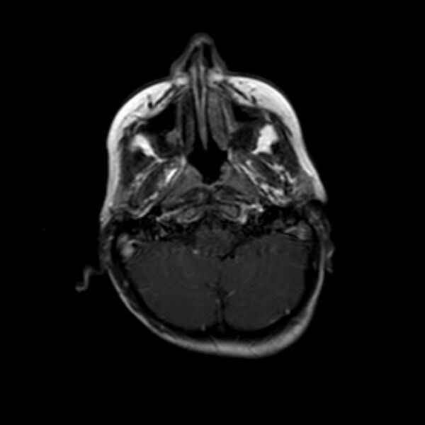 File:Cerebral tuberculoma (Radiopaedia 41152-43932 Axial T1 C+ 3).jpg
