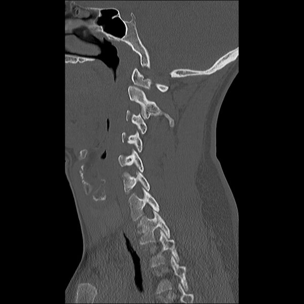 File:Cervical facet fracture and anterior discoligamentous injury (Radiopaedia 32139-33083 Sagittal bone window 25).jpg