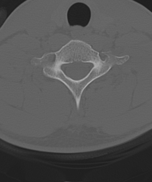 File:Cervical intercalary bone (Radiopaedia 35211-36748 Axial bone window 51).png