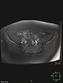 Cesarian scar endometriosis (Radiopaedia 68495-78066 Axial T1 C+ fat sat 5).jpg