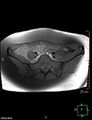 Cesarian scar endometriosis (Radiopaedia 68495-78066 Axial T1 fat sat 2).jpg