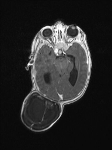 File:Chiari III malformation with occipital encephalocele (Radiopaedia 79446-92559 Axial T1 C+ mpr 43).jpg