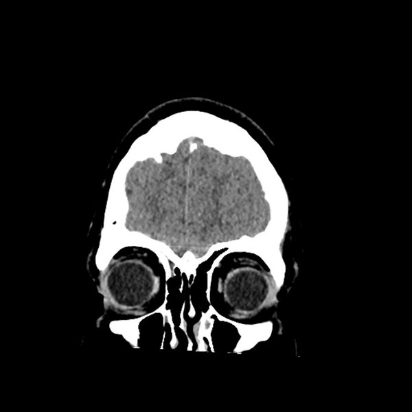 File:Chiasmatic-hypothalamic juvenile pilocytic astrocytoma (Radiopaedia 78533-91237 Coronal non-contrast 13).jpg