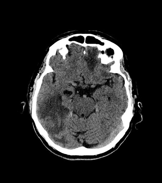 File:Cholangiocarcinoma with cerebral metastases (Radiopaedia 83519-98628 Axial non-contrast 28).jpg