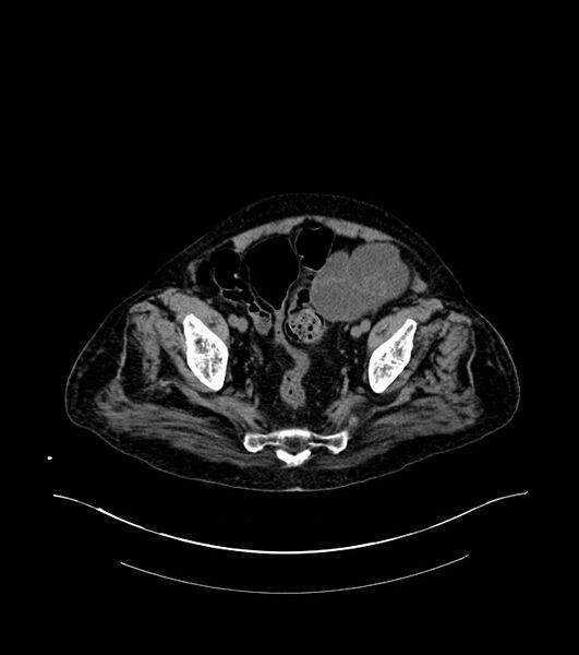 File:Cholangiocarcinoma with cerebral metastases (Radiopaedia 83519-98629 Axial non-contrast 108).jpg