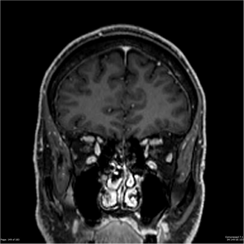Chondrosarcoma of skull base- grade II (Radiopaedia 40948-43654 Coronal T1 C+ 60).jpg
