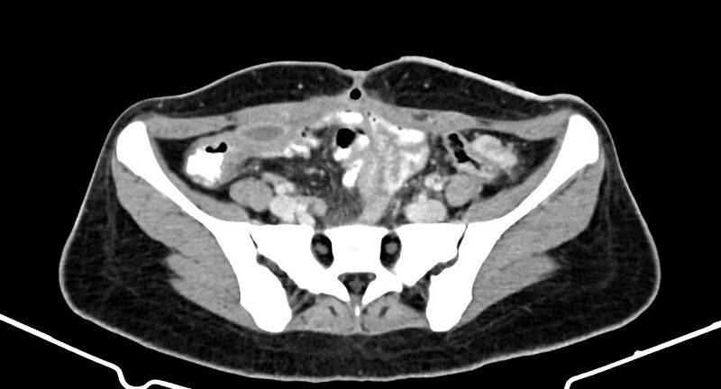 File:Choriocarcinoma liver metastases (Radiopaedia 74768-85766 A 155).jpg