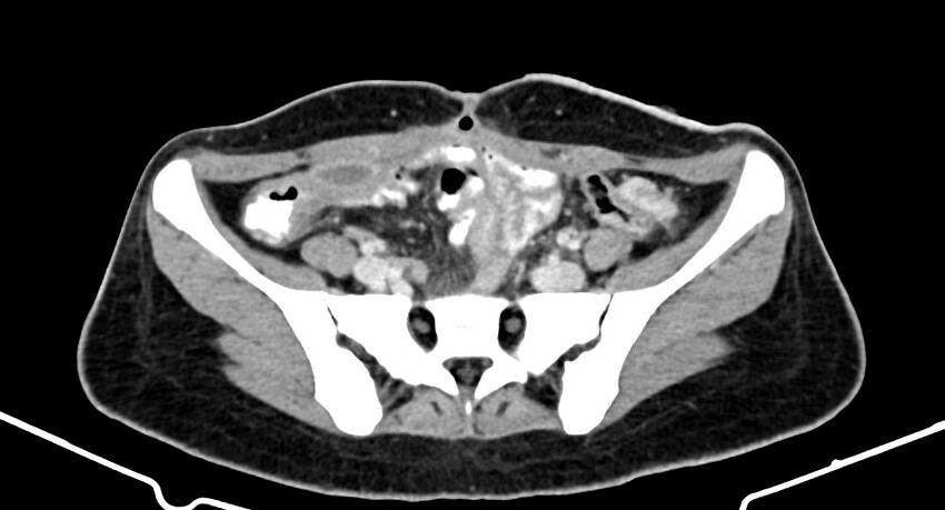 Choriocarcinoma liver metastases (Radiopaedia 74768-85766 A 155).jpg
