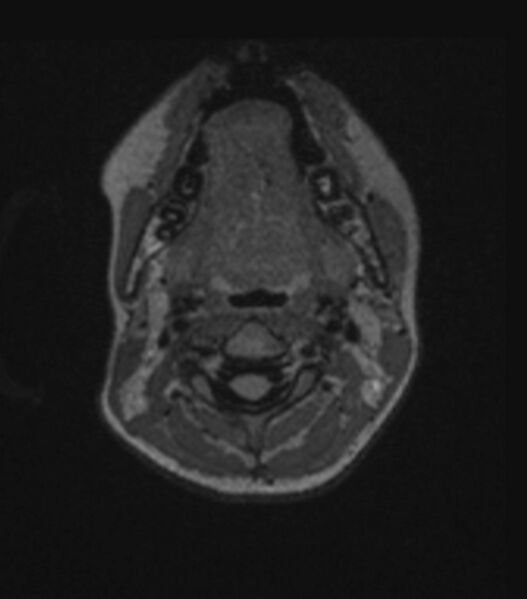 File:Choroid plexus carcinoma (Radiopaedia 91013-108553 Axial FLAIR C+ 38).jpg