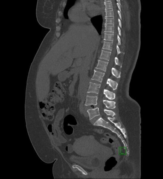 File:Chromophobe renal cell carcinoma (Radiopaedia 84239-99519 Sagittal bone window 59).jpg