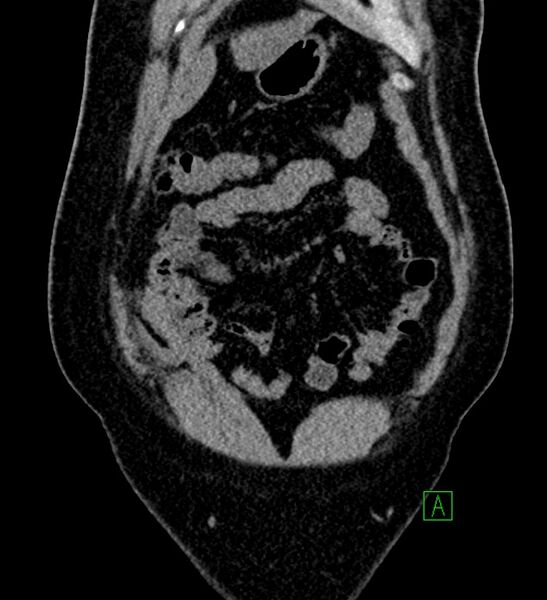 File:Chromophobe renal cell carcinoma (Radiopaedia 84286-99573 Coronal non-contrast 28).jpg