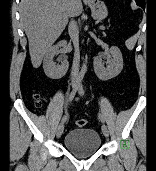 File:Chromophobe renal cell carcinoma (Radiopaedia 84286-99573 Coronal non-contrast 91).jpg