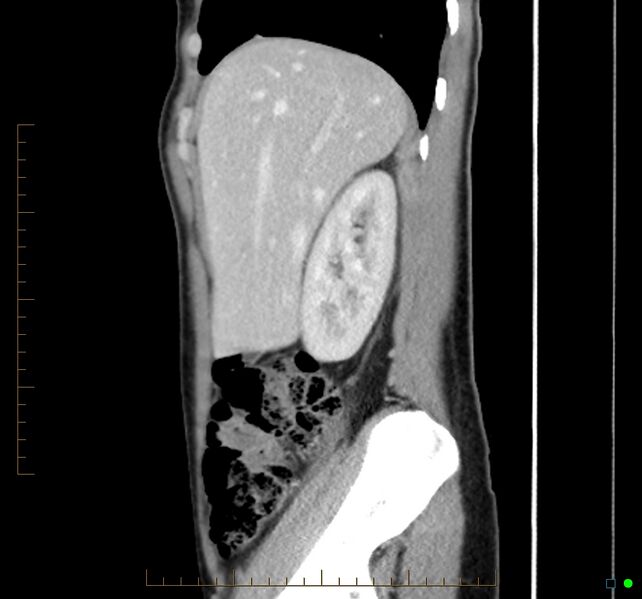 File:Chronic abscess due to "dropped" appendicoliths following appendectomy for perforated appendix (Radiopaedia 58805-66344 D 42).jpg