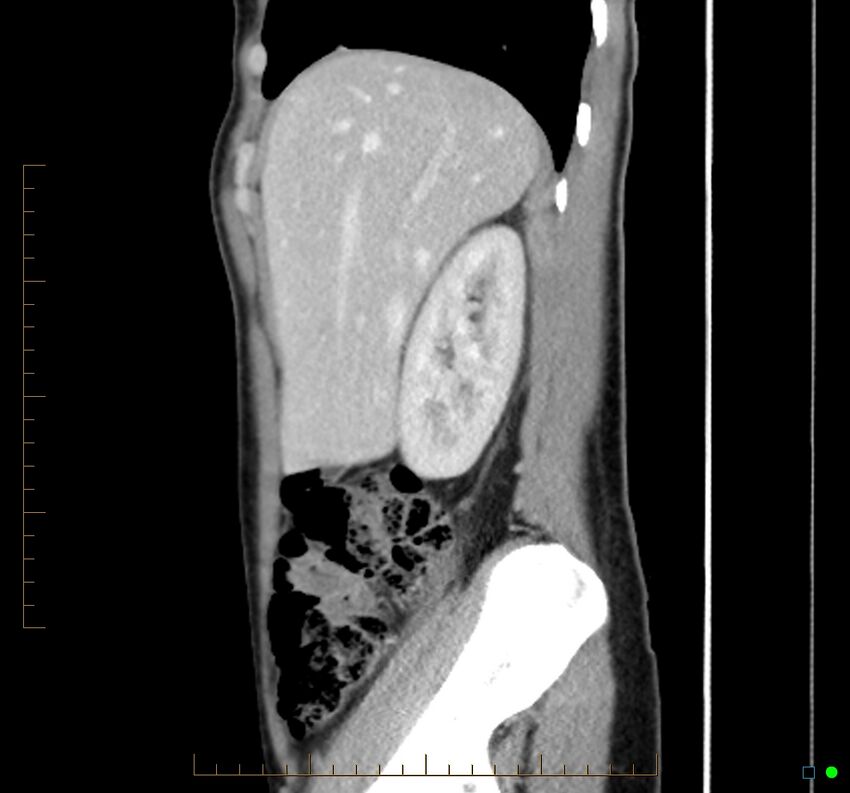 Chronic abscess due to "dropped" appendicoliths following appendectomy for perforated appendix (Radiopaedia 58805-66344 D 42).jpg