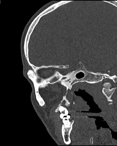 File:Chronic maxillary sinusitis caused by a foreign body (Radiopaedia 58521-65676 Sagittal bone window 59).jpg