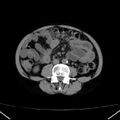 Chronic pancreatitis (Radiopaedia 23132-23172 Axial non-contrast 49).jpg