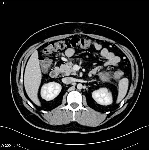 File:Chronic pancreatitis and pseudocysts (Radiopaedia 6724-7935 D 9).jpg