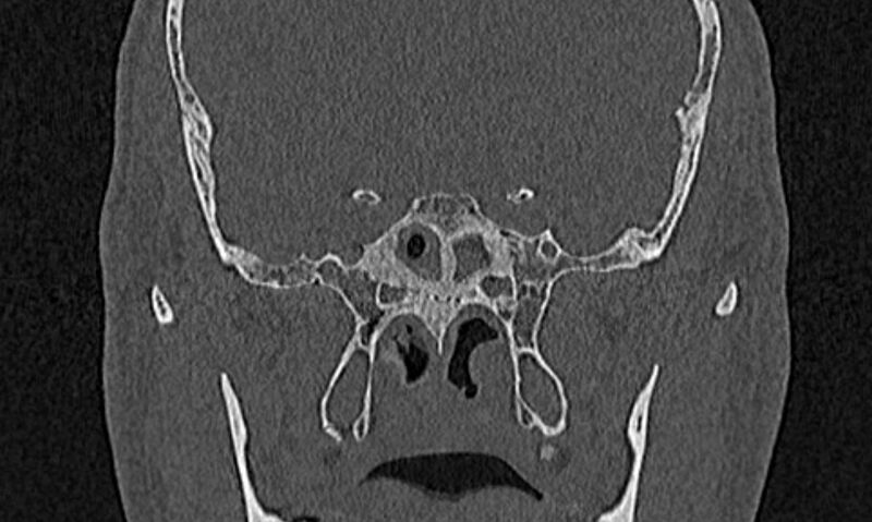 File:Chronic rhinosinusitis (Radiopaedia 65079-74075 Coronal bone window 68).jpg
