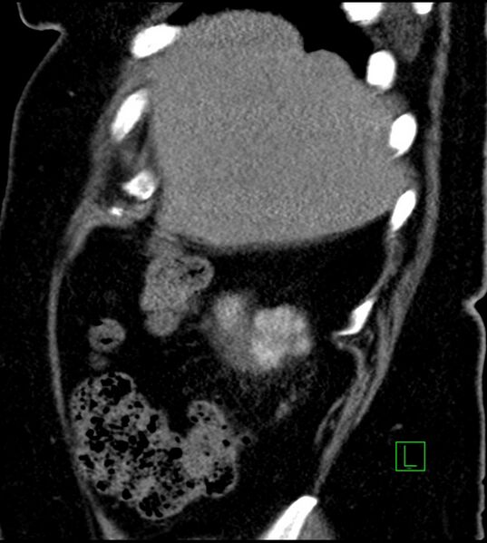 File:Clear cell renal cell carcinoma (Radiopaedia 85004-100537 D 54).jpg