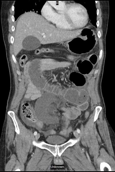 File:Closed loop bowel obstruction and ischemia (Radiopaedia 86959-103180 B 12).jpg
