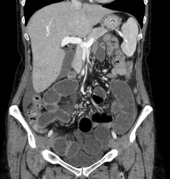 File:Closed loop small bowel obstruction (Radiopaedia 71211-81508 B 41).jpg