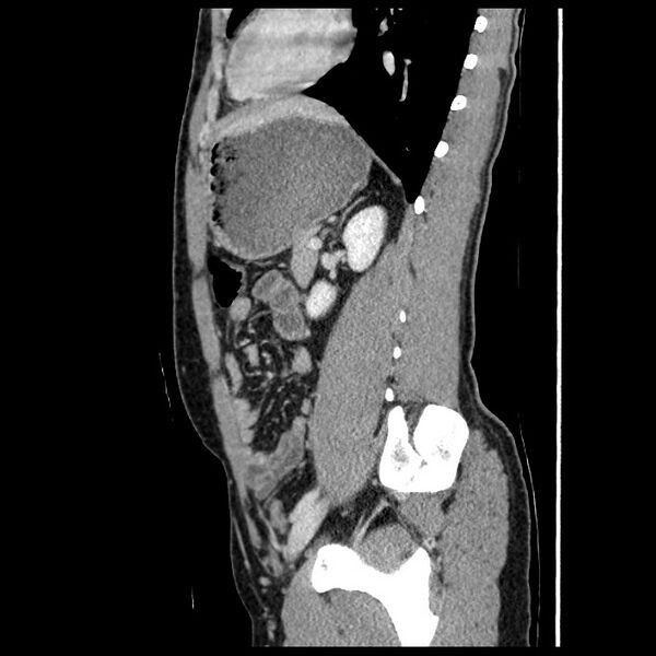 File:Co-existing acute appendicitis and epiploic appendagitis (Radiopaedia 61789-69911 B 64).jpg