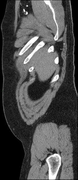 File:Coarctation of the aorta (Radiopaedia 74632-88521 C 19).jpg